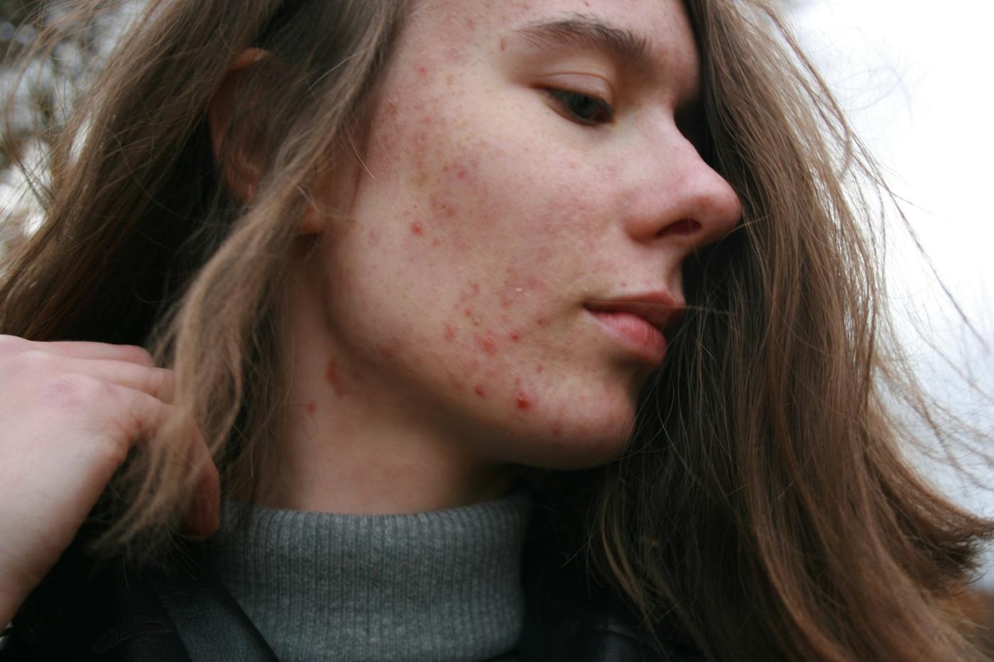Jonge vrouw in profiel met zichtbare acne op wang en kaaklijn